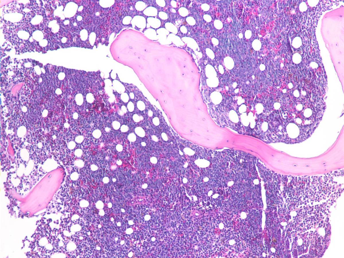 Figure 6. 5-27-10 Bone Marrow Biopsy, H&E, 100x